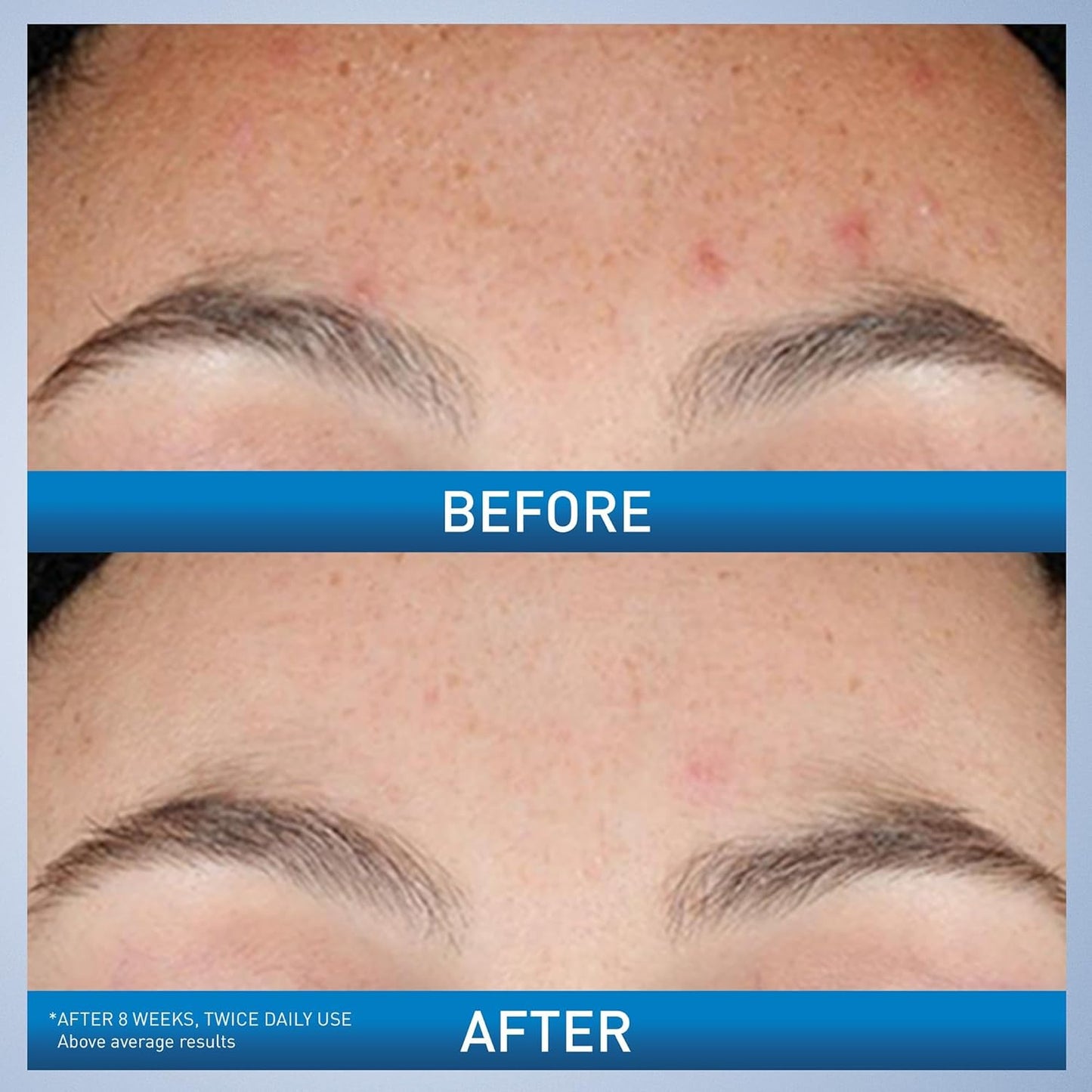 CeraVe Resurfacing Retinol Serum For Post Acne Marks, Post Acne Skin Barrier Repair, Non-Comedogenic 1 oz (30 ml)